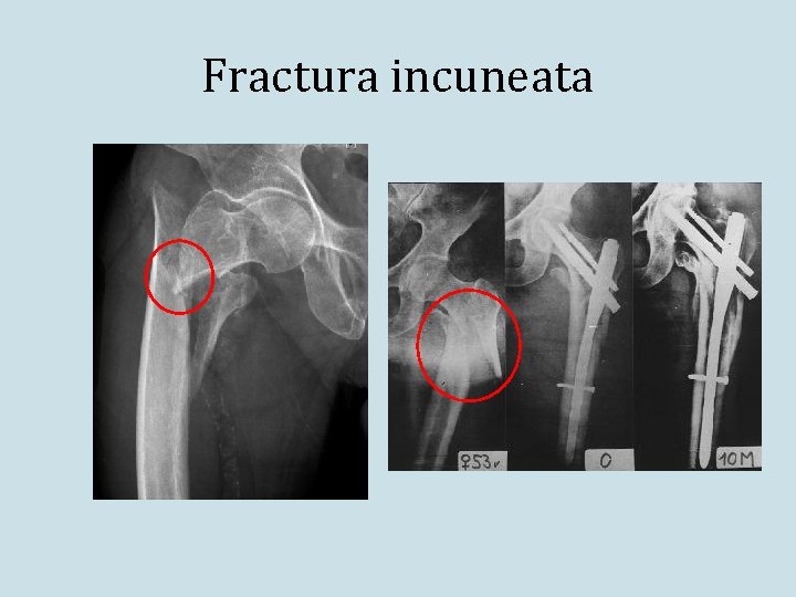 Fractura incuneata 