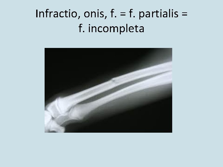 Infractio, onis, f. = f. partialis = f. incompleta 