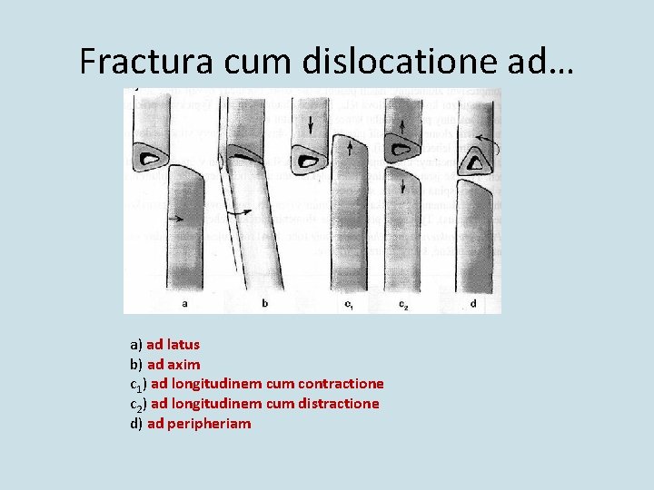 Fractura cum dislocatione ad… a) ad latus b) ad axim c 1) ad longitudinem