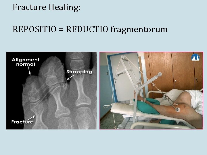 Fracture Healing: REPOSITIO = REDUCTIO fragmentorum 