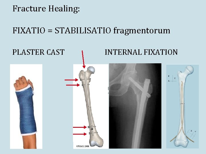 Fracture Healing: FIXATIO = STABILISATIO fragmentorum PLASTER CAST INTERNAL FIXATION 
