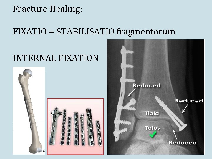 Fracture Healing: FIXATIO = STABILISATIO fragmentorum INTERNAL FIXATION 