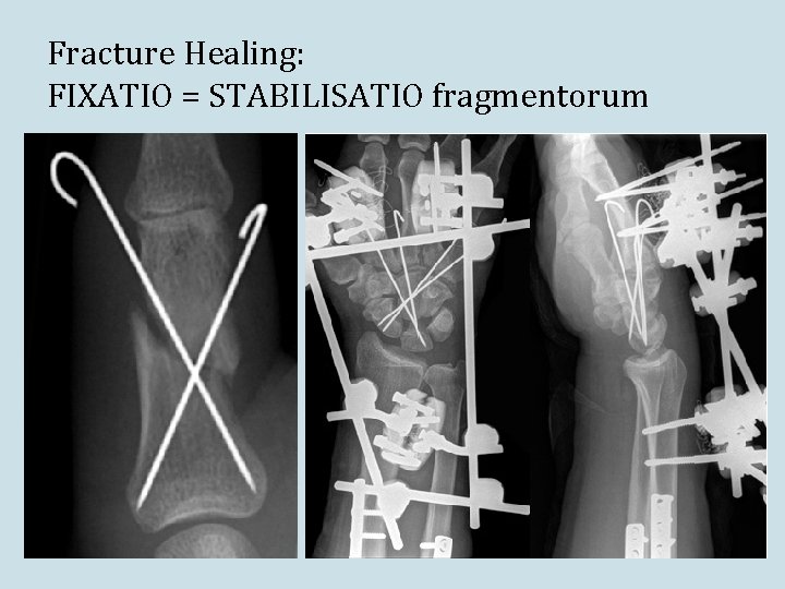 Fracture Healing: FIXATIO = STABILISATIO fragmentorum 