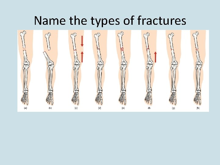 Name the types of fractures 