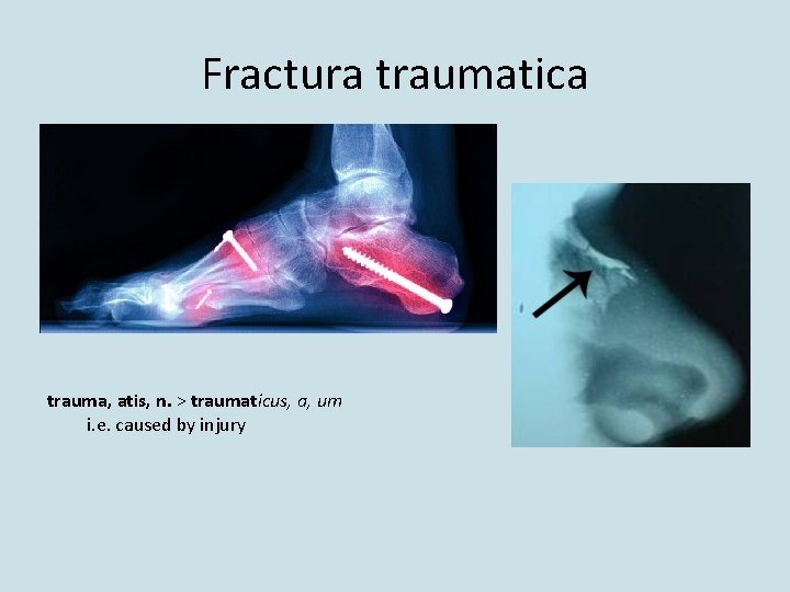 Fractura traumatica trauma, atis, n. > traumaticus, a, um i. e. caused by injury
