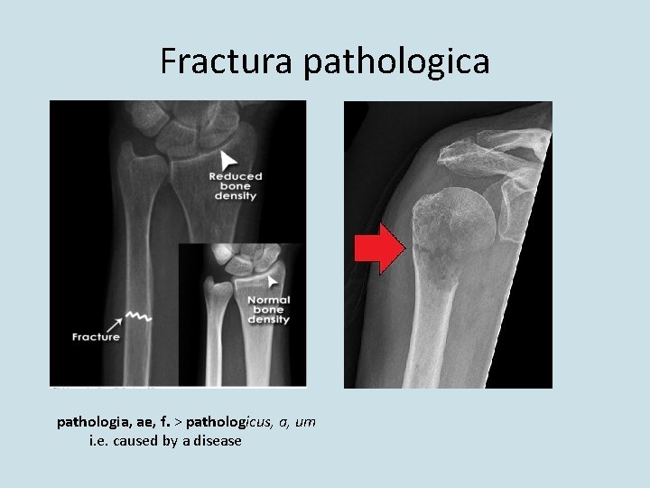 Fractura pathologica pathologia, ae, f. > pathologicus, a, um i. e. caused by a