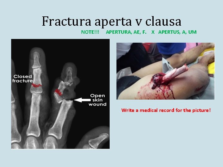Fractura aperta v clausa NOTE!!! APERTURA, AE, F. X APERTUS, A, UM Write a