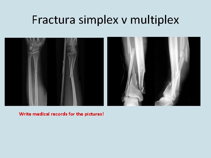 Fractura simplex v multiplex Write medical records for the pictures! 