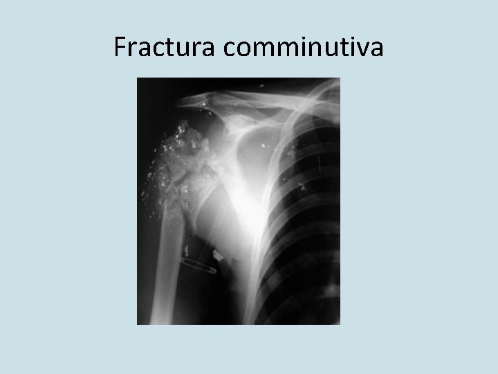Fractura comminutiva 