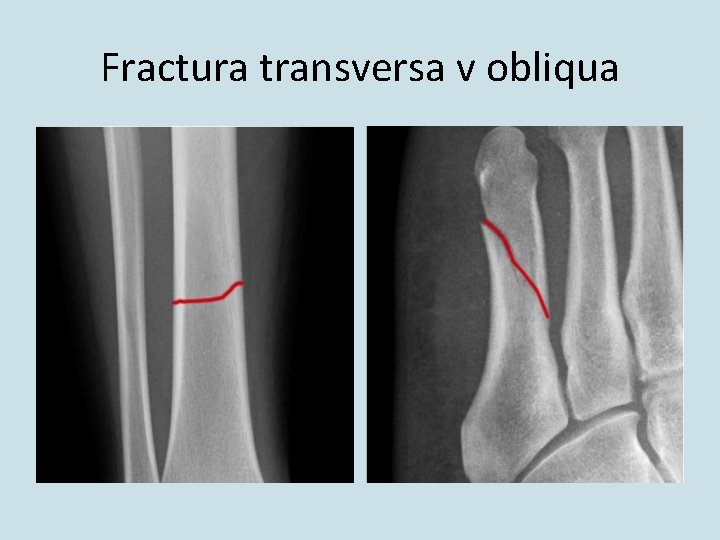 Fractura transversa v obliqua 