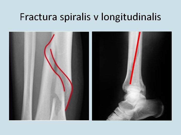 Fractura spiralis v longitudinalis 