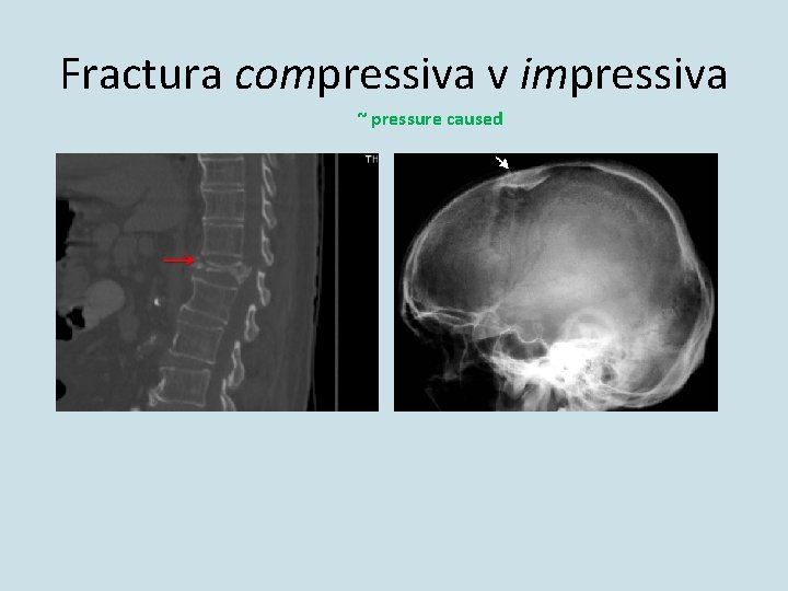 Fractura compressiva v impressiva ~ pressure caused 