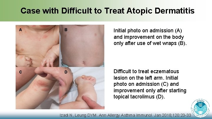 Case with Difficult to Treat Atopic Dermatitis A B Initial photo on admission (A)