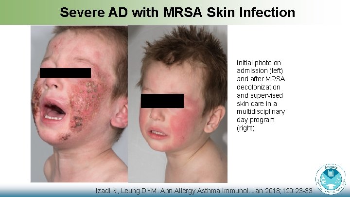 Severe AD with MRSA Skin Infection Initial photo on admission (left) and after MRSA