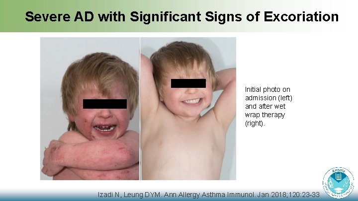 Severe AD with Significant Signs of Excoriation Initial photo on admission (left) and after