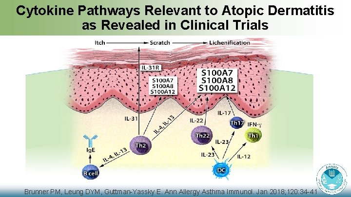 Cytokine Pathways Relevant to Atopic Dermatitis as Revealed in Clinical Trials Brunner PM, Leung