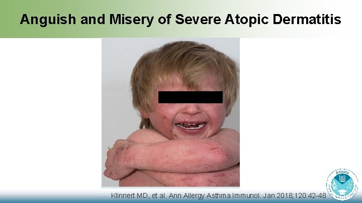 Anguish and Misery of Severe Atopic Dermatitis Klinnert MD, et al. Ann Allergy Asthma