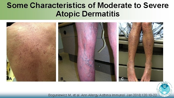 Some Characteristics of Moderate to Severe Atopic Dermatitis Boguniewicz M, et al. Ann Allergy