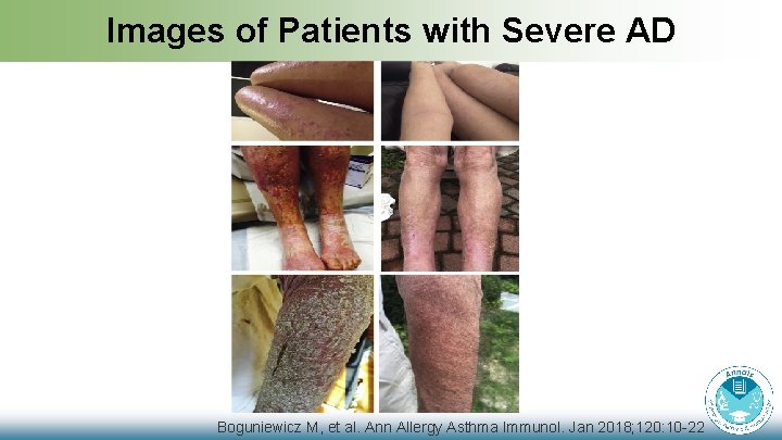 Images of Patients with Severe AD Boguniewicz M, et al. Ann Allergy Asthma Immunol.
