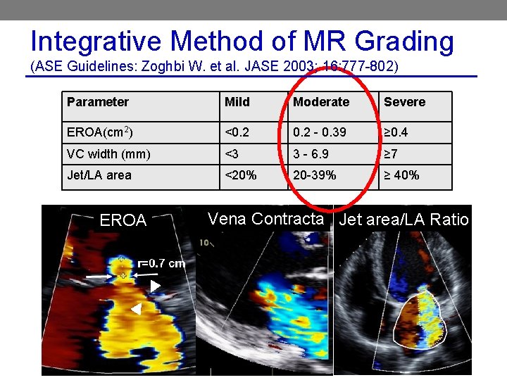 Integrative Method of MR Grading (ASE Guidelines: Zoghbi W. et al. JASE 2003; 16: