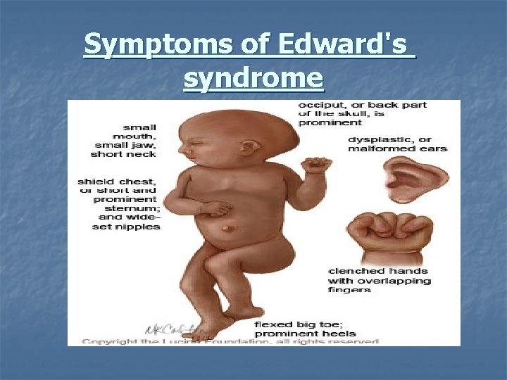 Symptoms of Edward's syndrome 