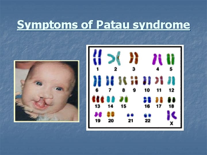 Symptoms of Patau syndrome 