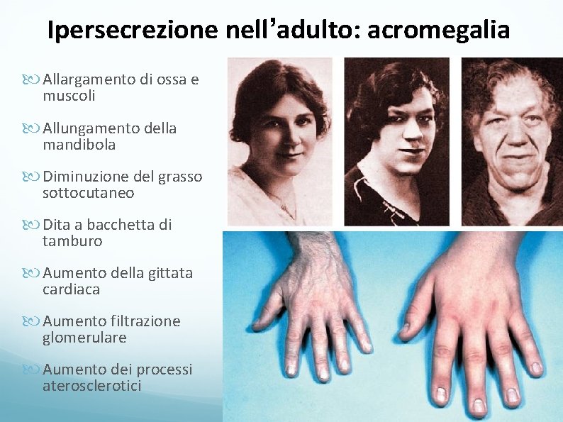 Ipersecrezione nell’adulto: acromegalia Allargamento di ossa e muscoli Allungamento della mandibola Diminuzione del grasso