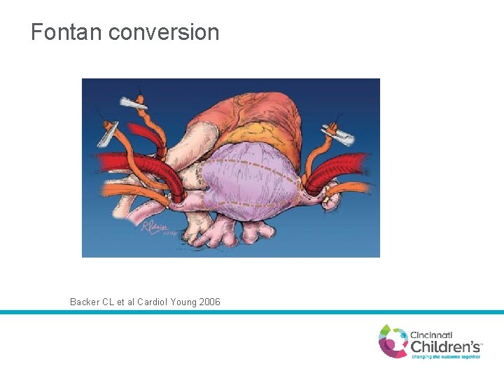 Fontan conversion Backer CL et al Cardiol Young 2006 