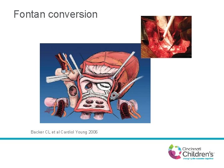 Fontan conversion Backer CL et al Cardiol Young 2006 
