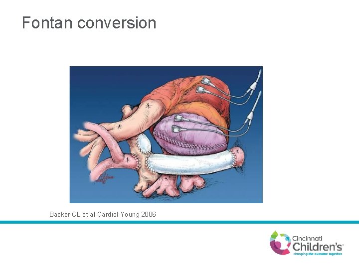 Fontan conversion Backer CL et al Cardiol Young 2006 