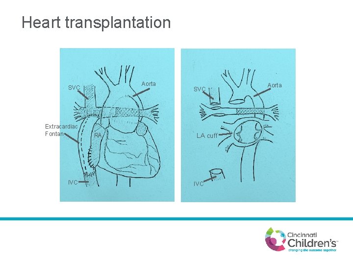 Heart transplantation Aorta SVC Extracardiac Fontan IVC RA SVC LA cuff IVC Aorta 