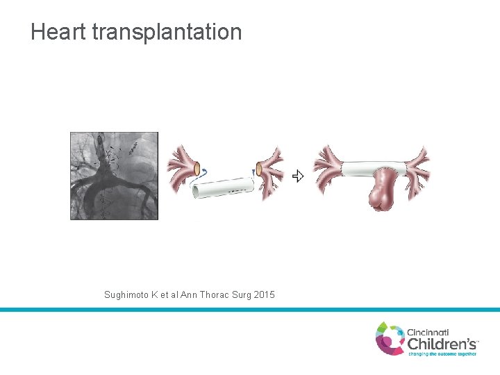 Heart transplantation Sughimoto K et al Ann Thorac Surg 2015 