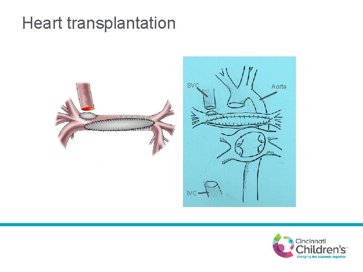 Heart transplantation SVC IVC Aorta 