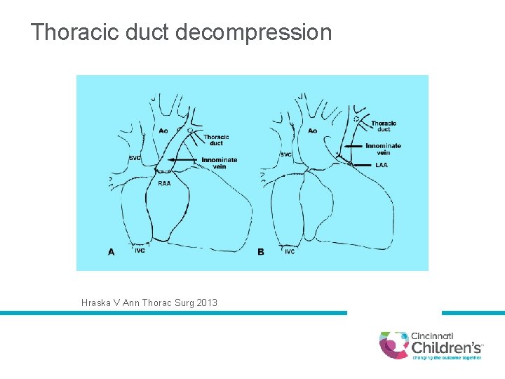 Thoracic duct decompression Hraska V Ann Thorac Surg 2013 