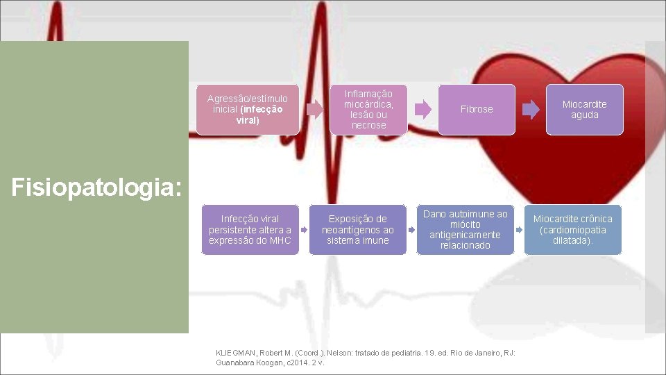 Agressão/estímulo inicial (infecção viral) Inflamação miocárdica, lesão ou necrose Fibrose Miocardite aguda Fisiopatologia: Infecção