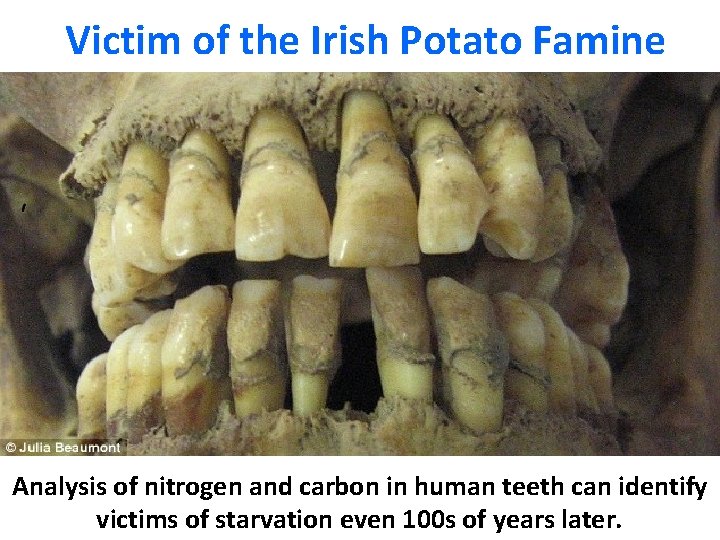 Victim of the Irish Potato Famine Analysis of nitrogen and carbon in human teeth