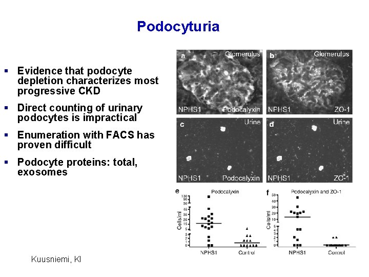 Podocyturia § Evidence that podocyte depletion characterizes most progressive CKD § Direct counting of