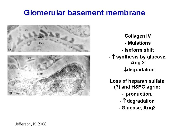 Glomerular basement membrane Collagen IV - Mutations - Isoform shift - synthesis by glucose,