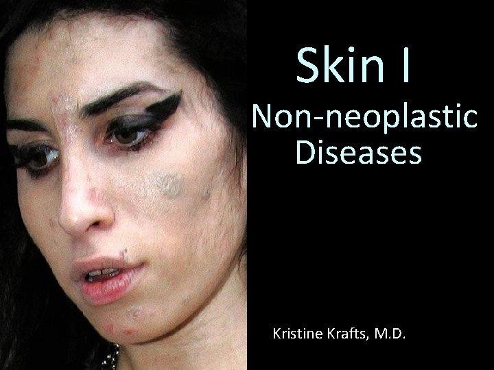 Skin I Non-neoplastic Diseases Kristine Krafts, M. D. 