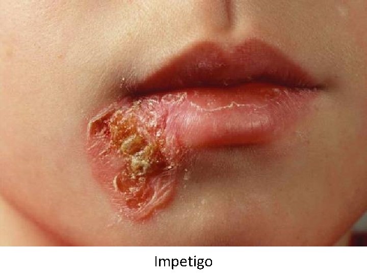 Impetigo 