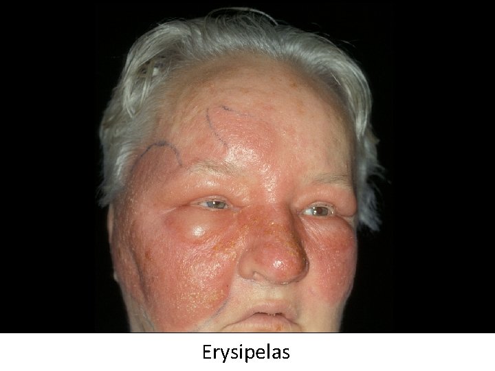 Erysipelas 