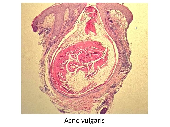 Acne vulgaris 