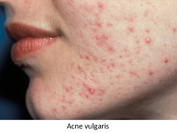 Acne vulgaris 