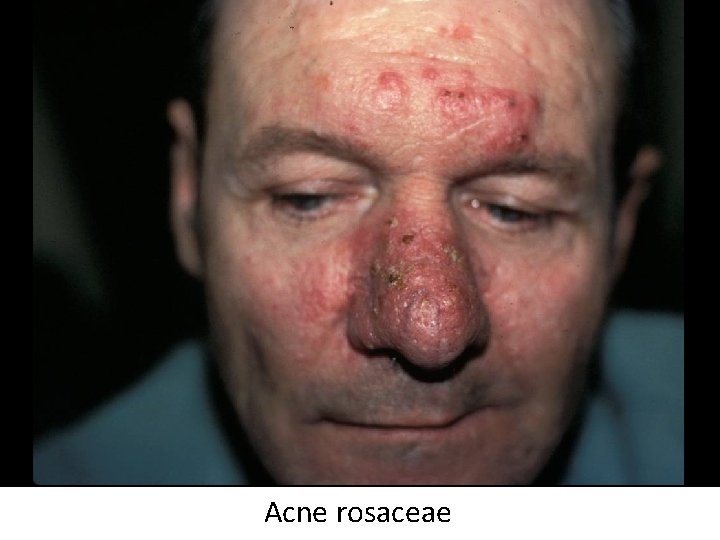 Acne rosaceae 