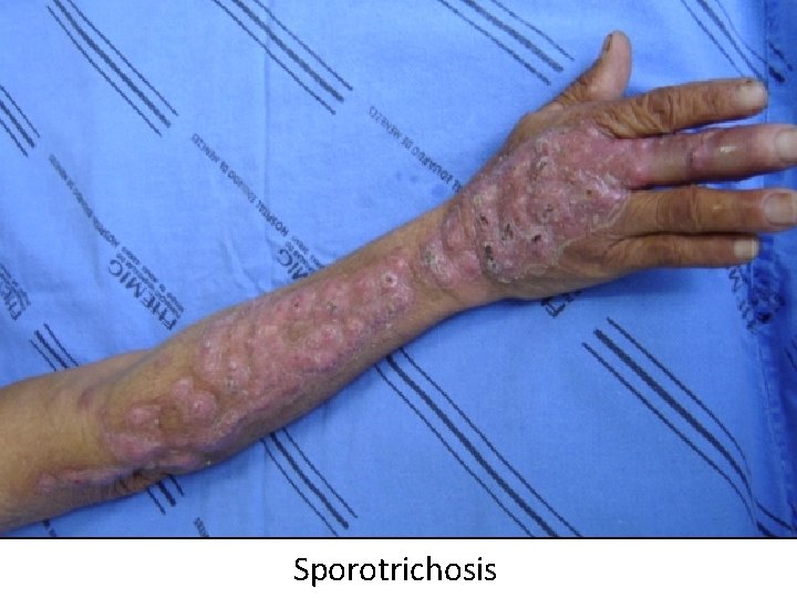 Sporotrichosis 