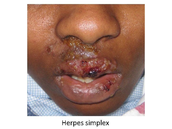 Herpes simplex 