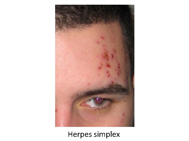 Herpes simplex 