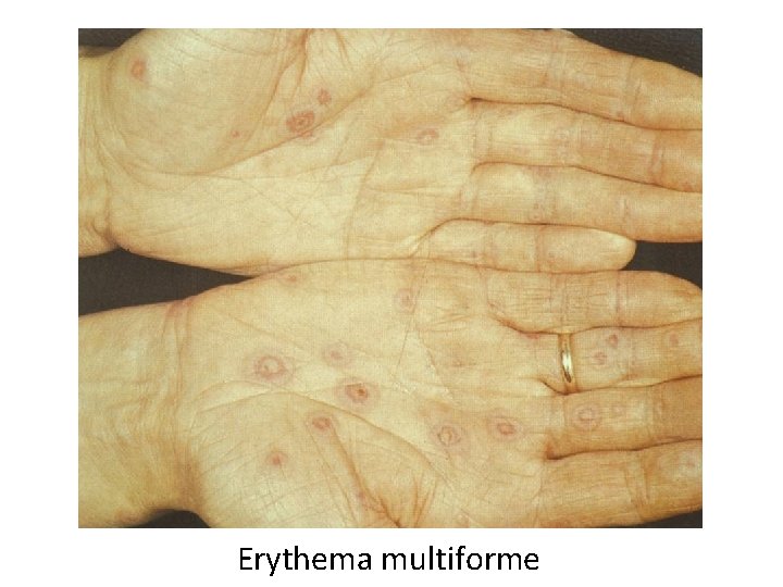 Erythema multiforme 