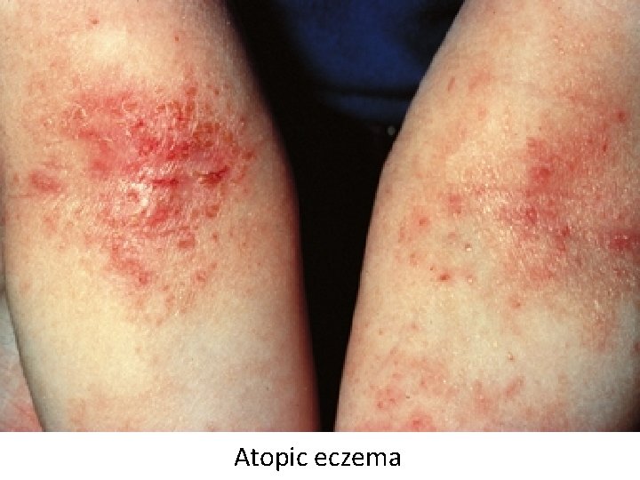 Atopic eczema 