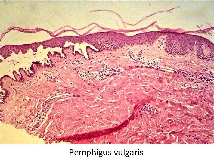 Pemphigus vulgaris 